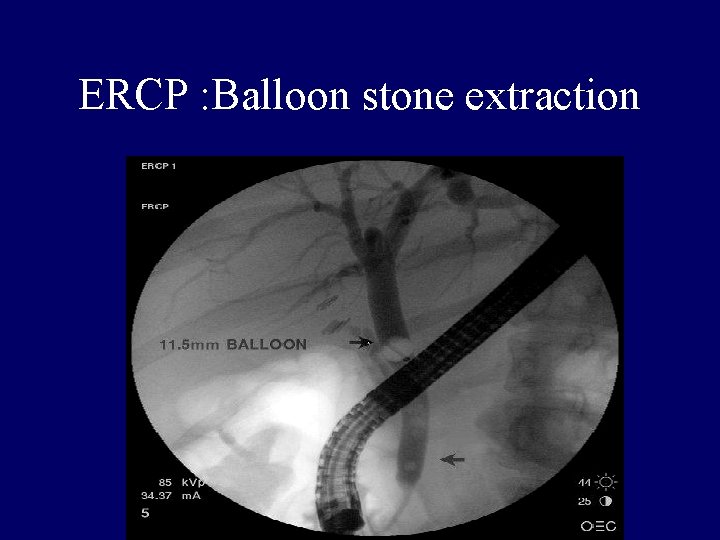 ERCP : Balloon stone extraction 