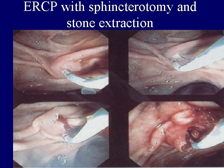 ERCP with sphincterotomy and stone extraction 