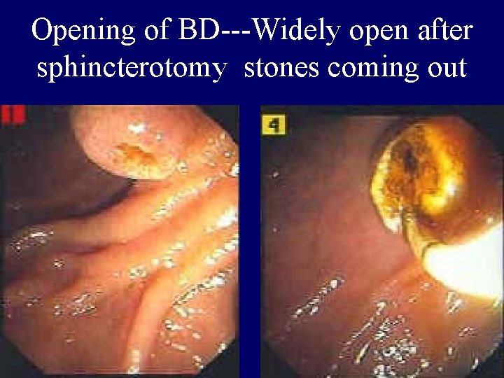 Opening of BD---Widely open after sphincterotomy stones coming out 