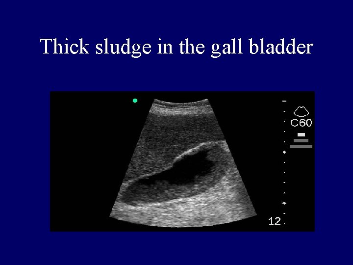 Thick sludge in the gall bladder 