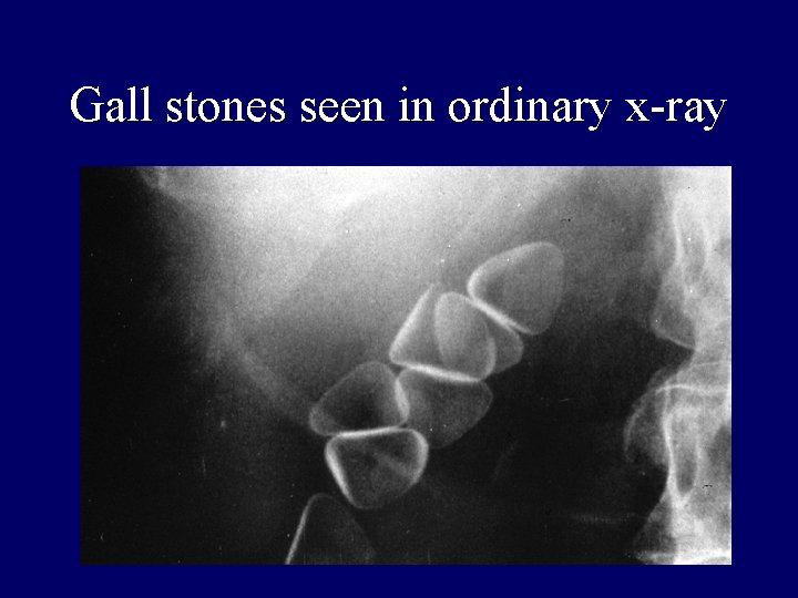 Gall stones seen in ordinary x-ray 