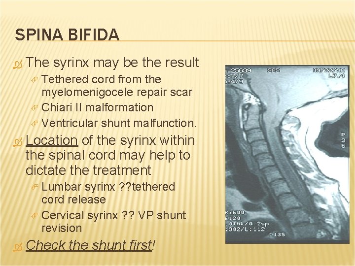 SPINA BIFIDA The syrinx may be the result Tethered cord from the myelomenigocele repair