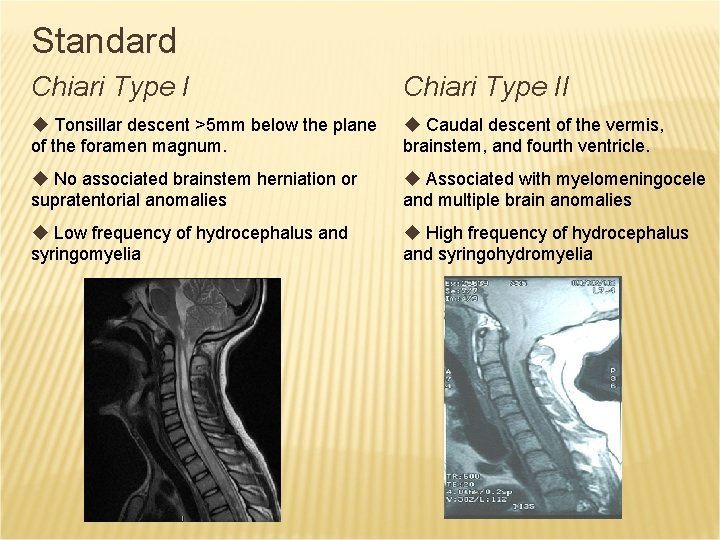 Standard Chiari Type II u Tonsillar descent >5 mm below the plane of the