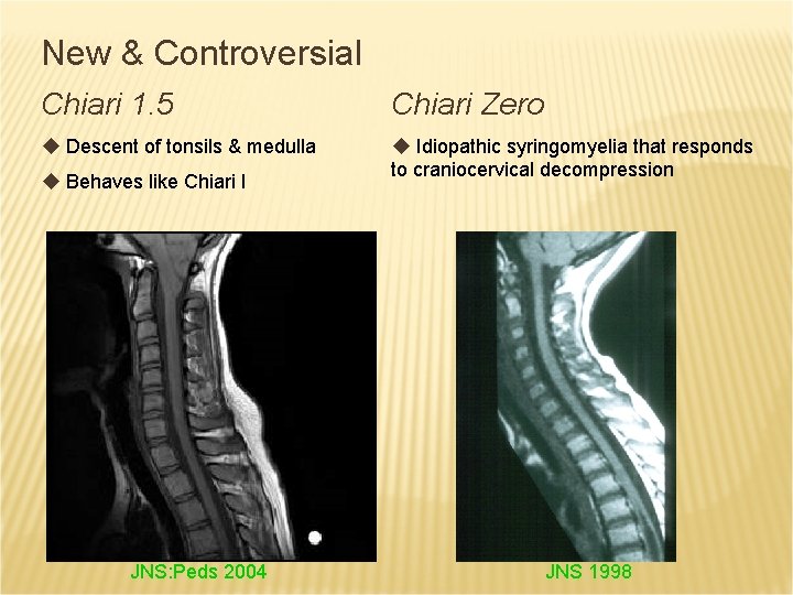 New & Controversial Chiari 1. 5 Chiari Zero u Descent of tonsils & medulla