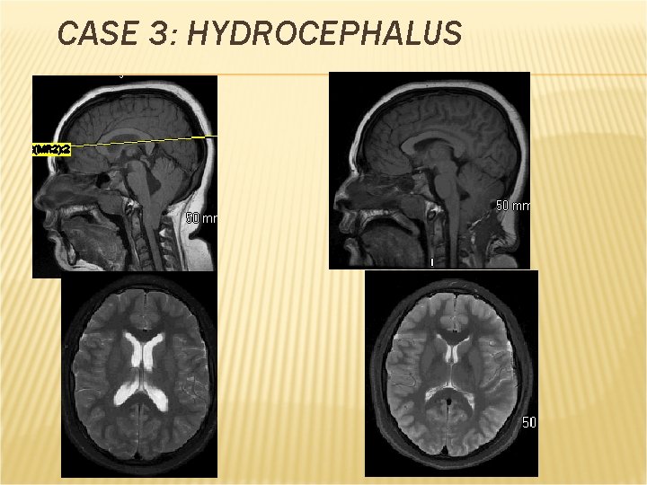 CASE 3: HYDROCEPHALUS 