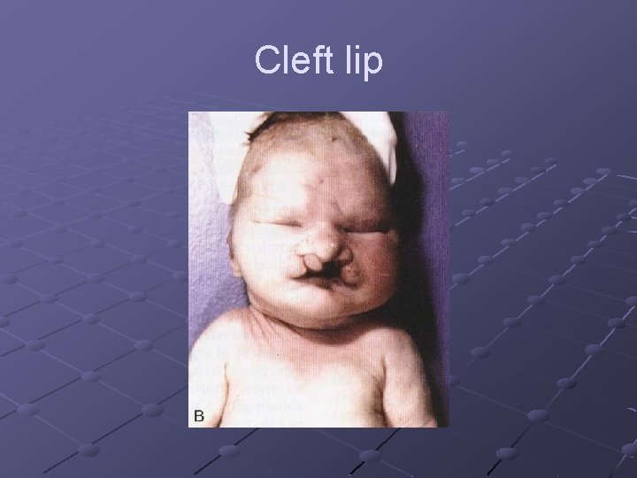 Cleft lip 
