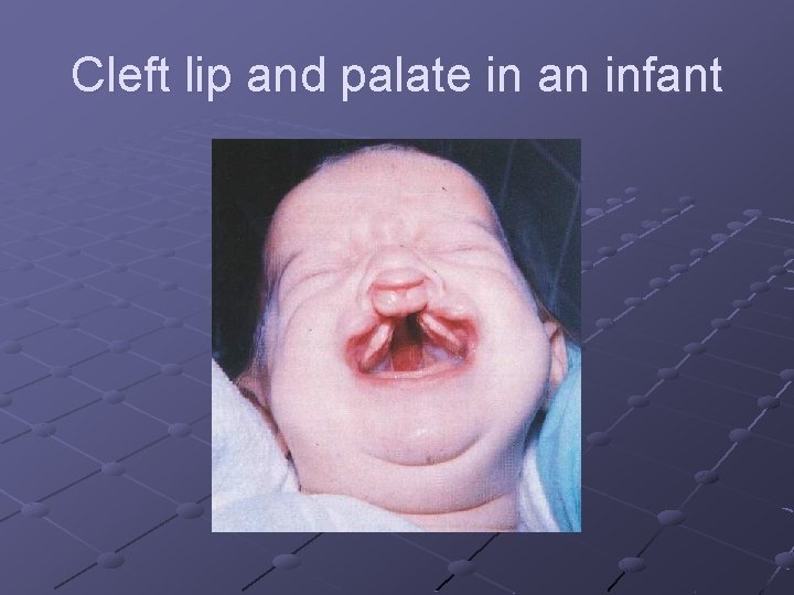 Cleft lip and palate in an infant 