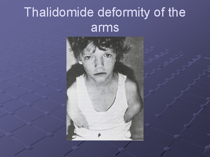 Thalidomide deformity of the arms 