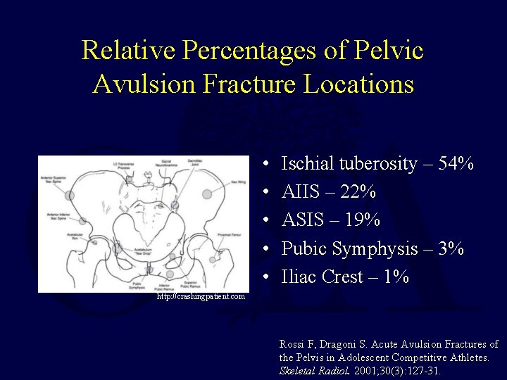 Relative Percentages of Pelvic Avulsion Fracture Locations • • • Ischial tuberosity – 54%