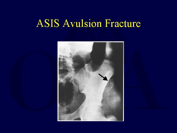 ASIS Avulsion Fracture 