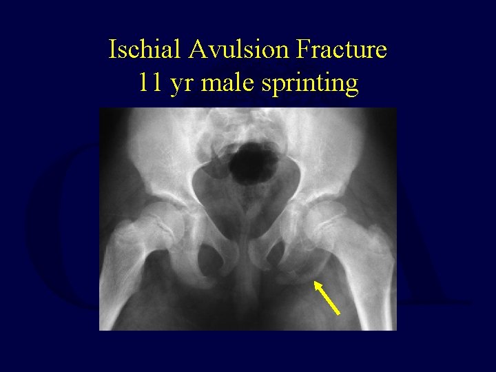 Ischial Avulsion Fracture 11 yr male sprinting 