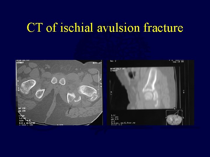 CT of ischial avulsion fracture 