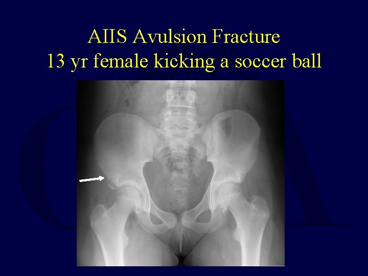 AIIS Avulsion Fracture 13 yr female kicking a soccer ball 