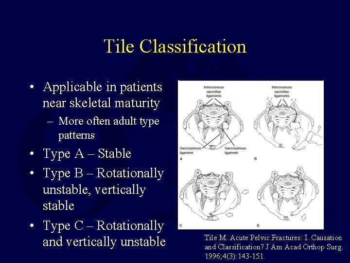 Tile Classification • Applicable in patients near skeletal maturity – More often adult type