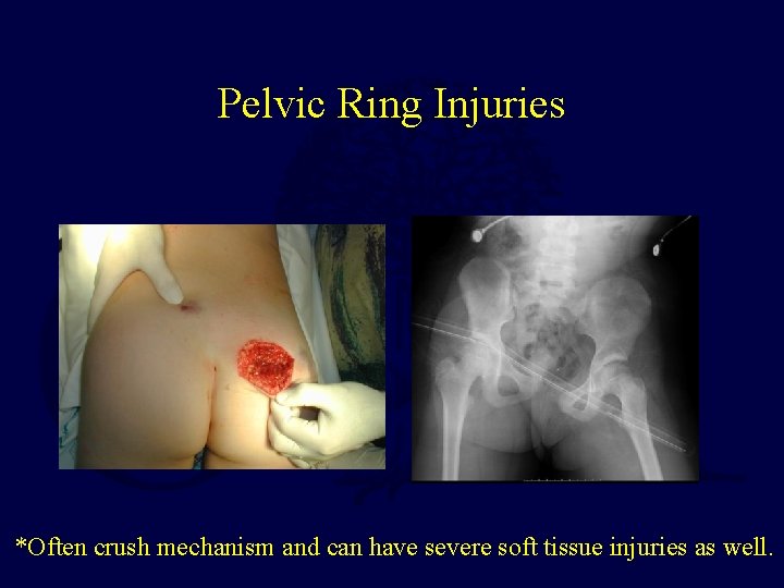 Pelvic Ring Injuries *Often crush mechanism and can have severe soft tissue injuries as