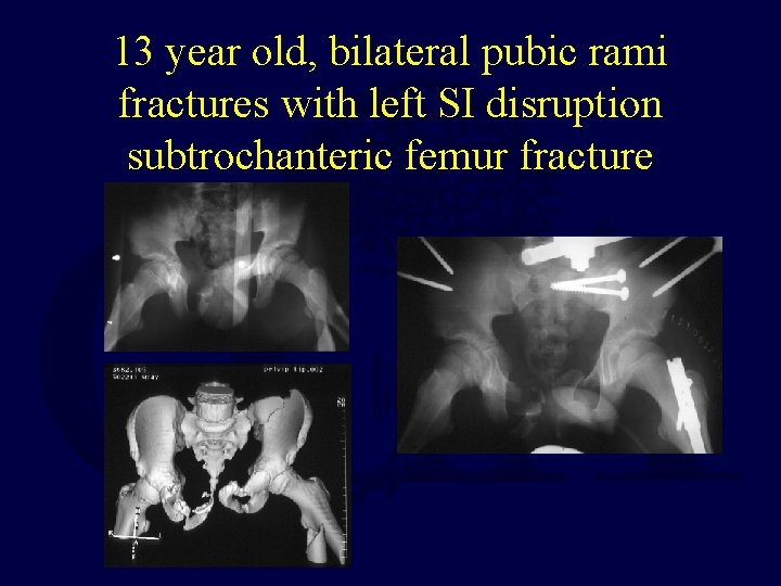 13 year old, bilateral pubic rami fractures with left SI disruption subtrochanteric femur fracture