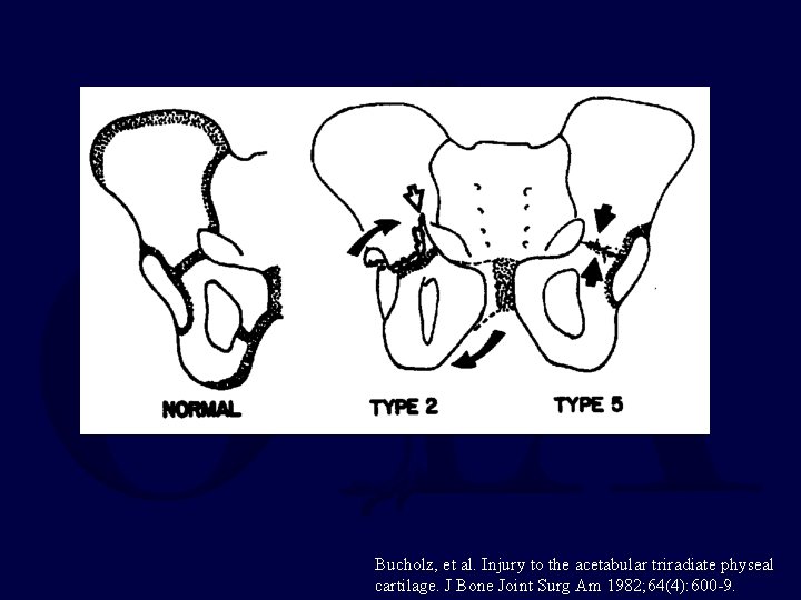 Bucholz, et al. Injury to the acetabular triradiate physeal cartilage. J Bone Joint Surg