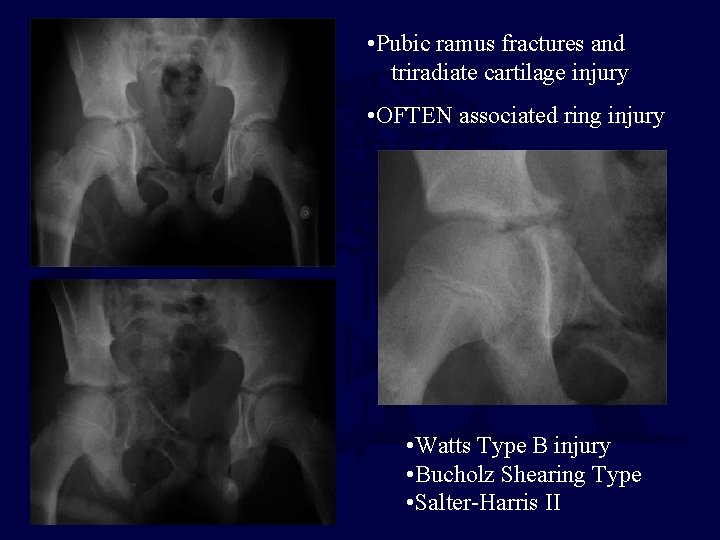  • Pubic ramus fractures and triradiate cartilage injury • OFTEN associated ring injury