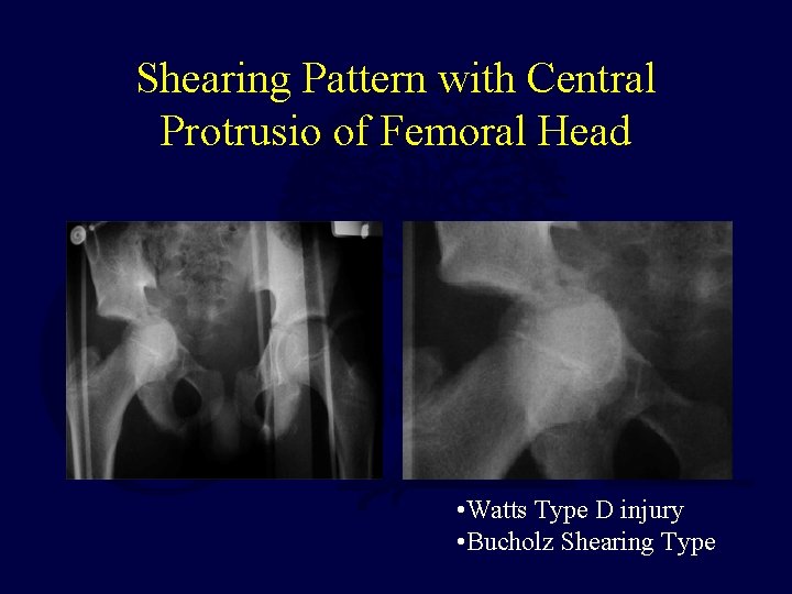 Shearing Pattern with Central Protrusio of Femoral Head • Watts Type D injury •