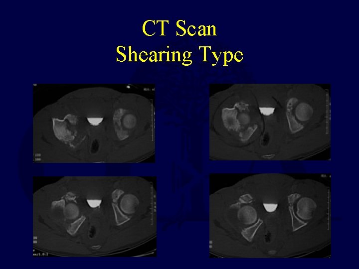 CT Scan Shearing Type 