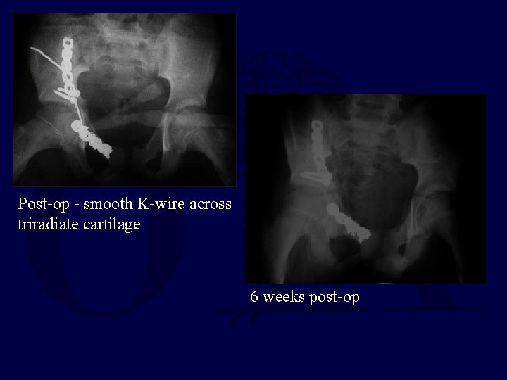 Post-op - smooth K-wire across triradiate cartilage 6 weeks post-op 