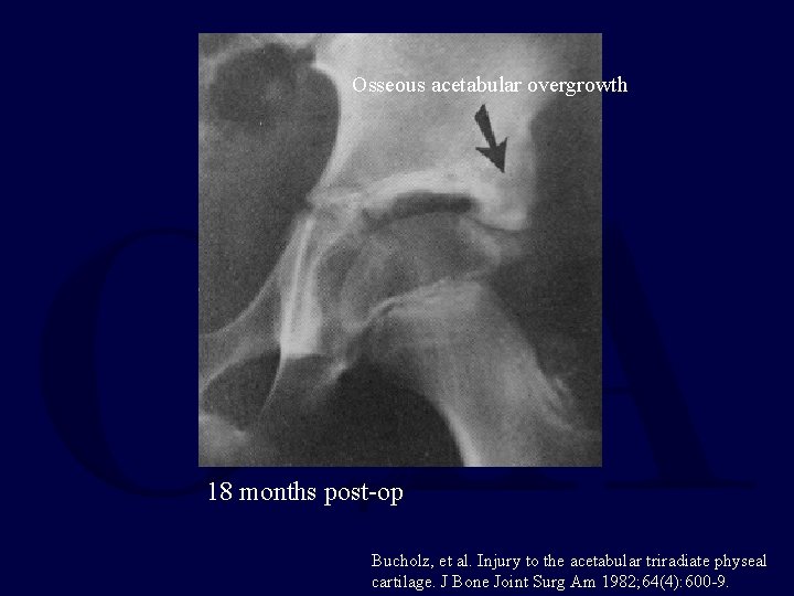 Osseous acetabular overgrowth 18 months post-op Bucholz, et al. Injury to the acetabular triradiate