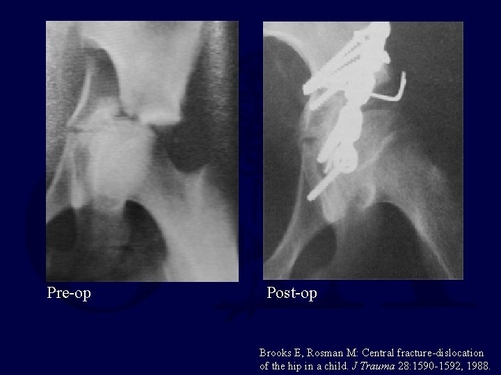 Pre-op Post-op Brooks E, Rosman M: Central fracture-dislocation of the hip in a child.