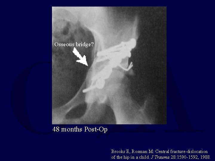Osseous bridge? 48 months Post-Op Brooks E, Rosman M: Central fracture-dislocation of the hip