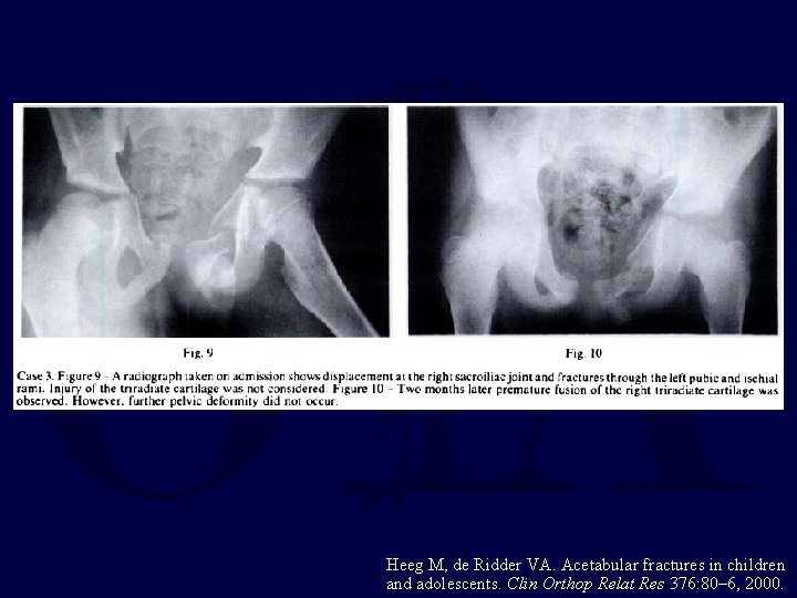 Heeg M, de Ridder VA. Acetabular fractures in children and adolescents. Clin Orthop Relat