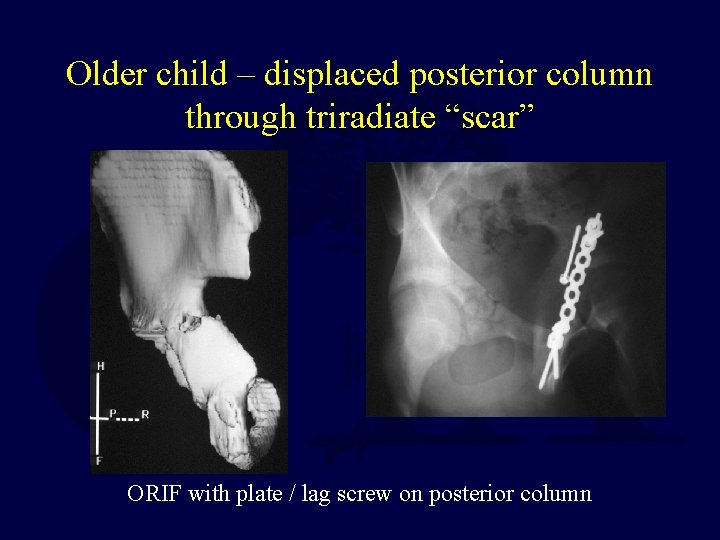 Older child – displaced posterior column through triradiate “scar” ORIF with plate / lag