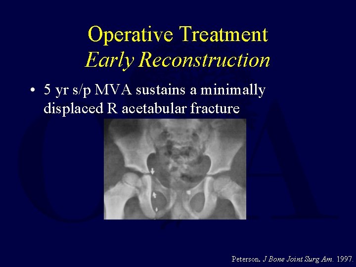 Operative Treatment Early Reconstruction • 5 yr s/p MVA sustains a minimally displaced R