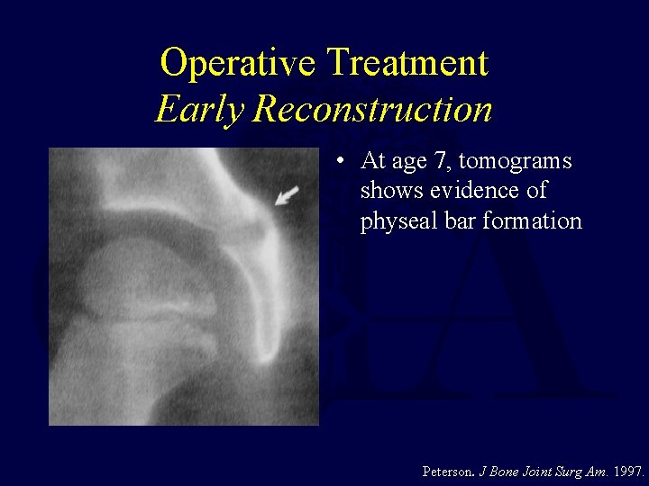 Operative Treatment Early Reconstruction • At age 7, tomograms shows evidence of physeal bar