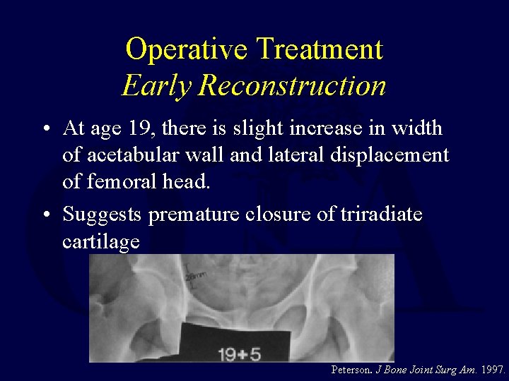 Operative Treatment Early Reconstruction • At age 19, there is slight increase in width