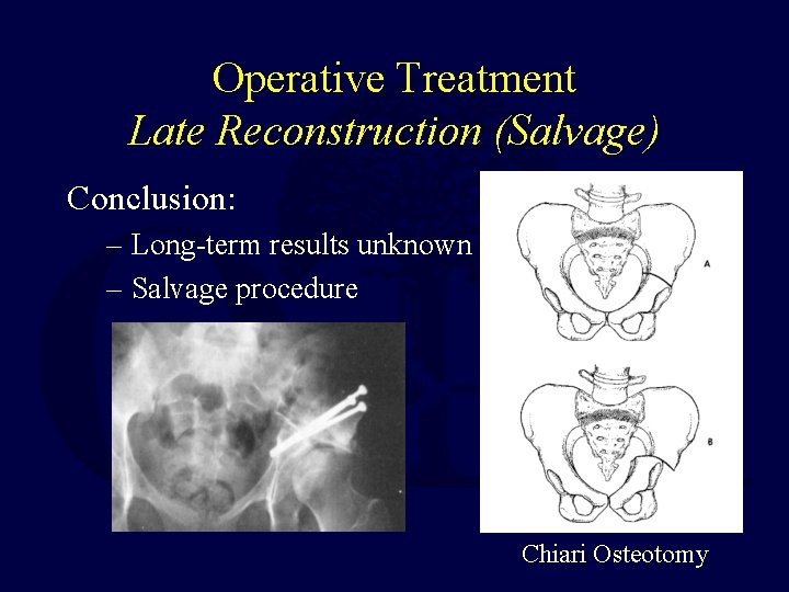 Operative Treatment Late Reconstruction (Salvage) Conclusion: – Long-term results unknown – Salvage procedure Chiari