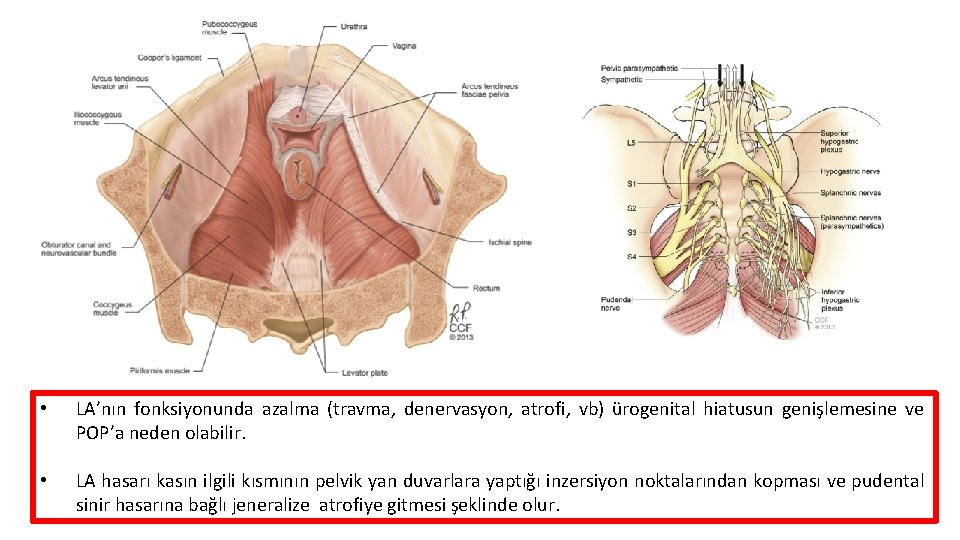  • LA’nın fonksiyonunda azalma (travma, denervasyon, atrofi, vb) ürogenital hiatusun genişlemesine ve POP’a