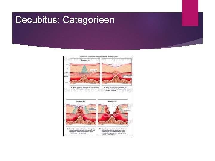 Decubitus: Categorieen 