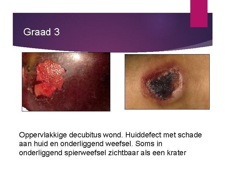 Graad 3 Oppervlakkige decubitus wond. Huiddefect met schade aan huid en onderliggend weefsel. Soms