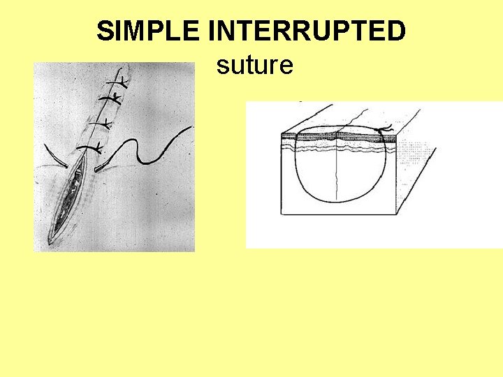 SIMPLE INTERRUPTED suture 