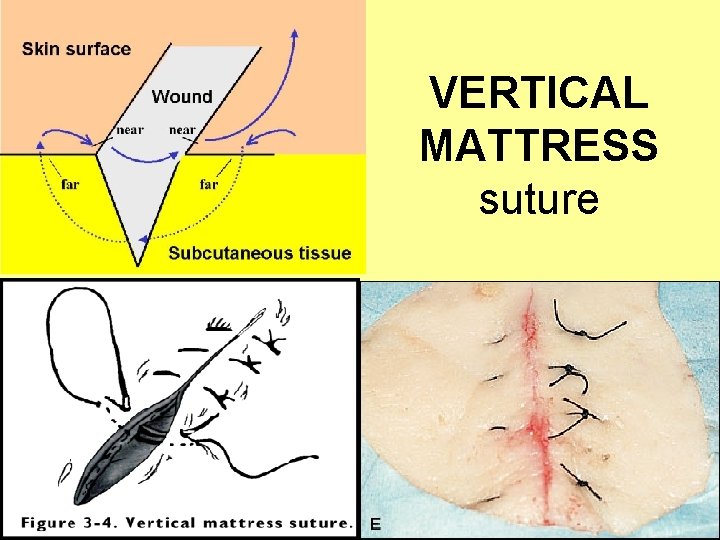 VERTICAL MATTRESS suture 