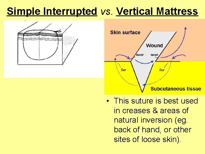 Simple Interrupted vs. Vertical Mattress • This suture is best used in creases &