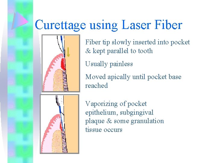 Curettage using Laser Fiber tip slowly inserted into pocket & kept parallel to tooth