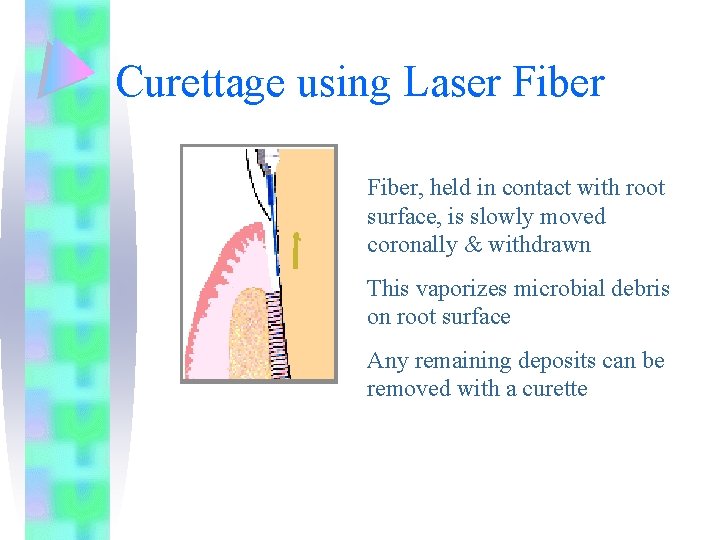 Curettage using Laser Fiber, held in contact with root surface, is slowly moved coronally