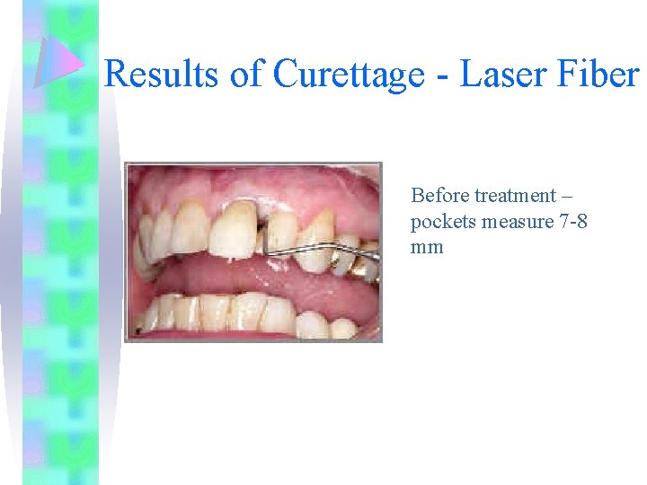 Results of Curettage - Laser Fiber Before treatment – pockets measure 7 -8 mm