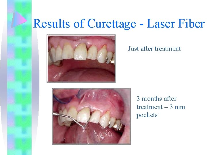 Results of Curettage - Laser Fiber Just after treatment 3 months after treatment –