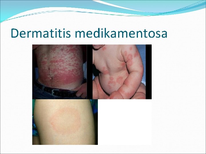 Dermatitis medikamentosa 