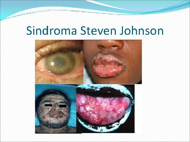 Sindroma Steven Johnson 