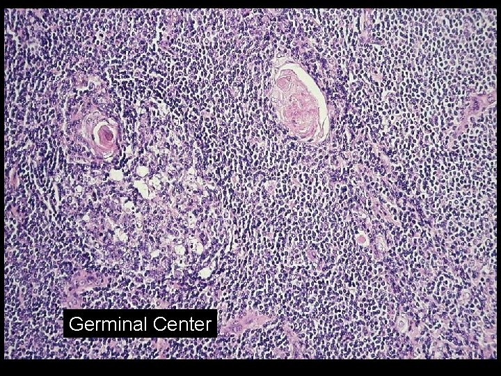 Lymphomas in the Mediastinum Mediastinal Large B Cell