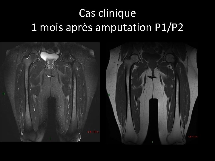 Cas clinique 1 mois après amputation P 1/P 2 