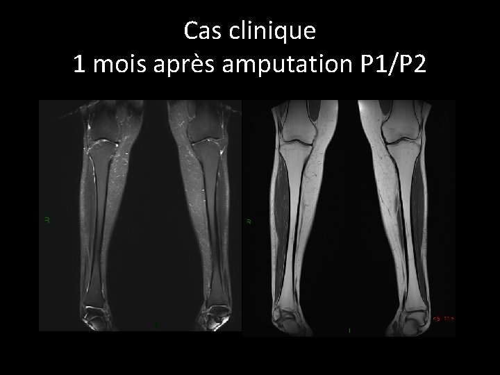 Cas clinique 1 mois après amputation P 1/P 2 