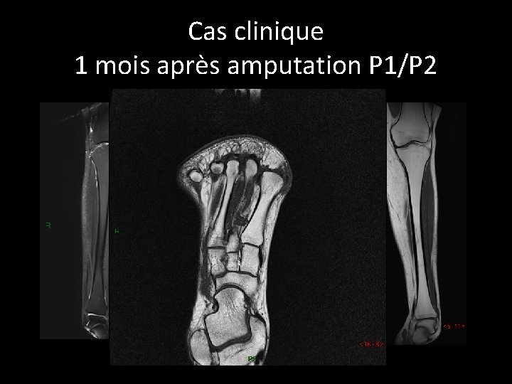 Cas clinique 1 mois après amputation P 1/P 2 